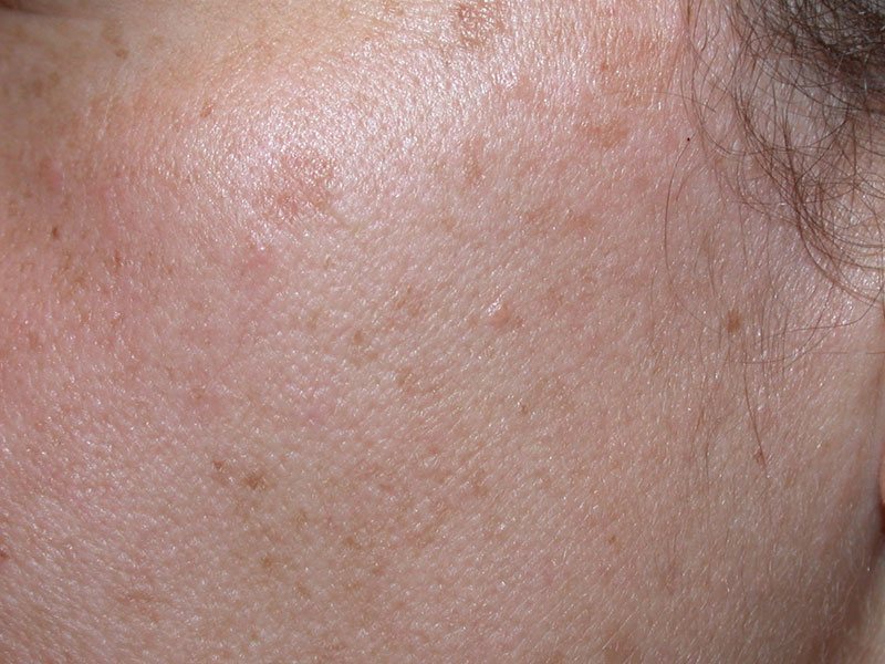 Before | The Cosmetic &amp; Skin Surgery Center