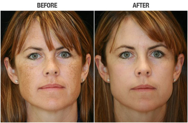 celebrate-spring-with-a-bbl-photofacial-the-cosmetic-skin-surgery