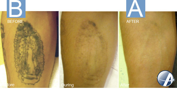 laser tattoo removal the cosmetic amp skin surgery center laser tattoo removal the cosmetic amp skin surgery center
