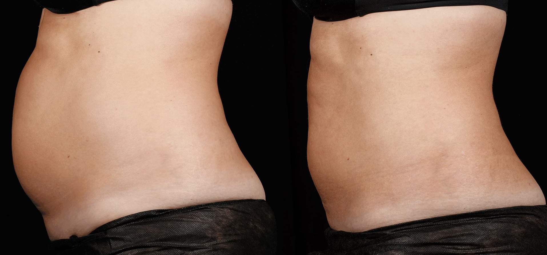 Before after Laser body.