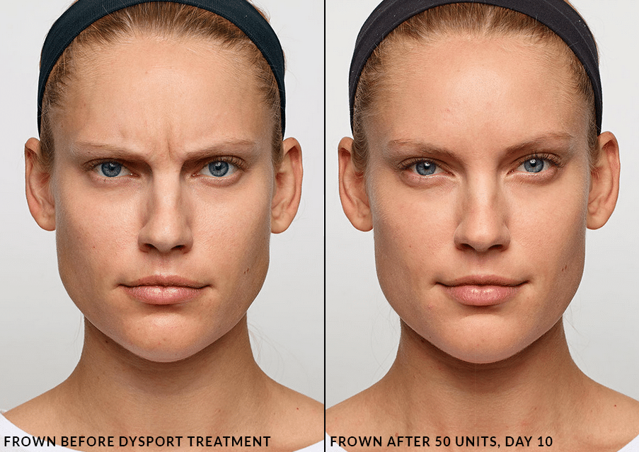dysportbeforeafter4 The Cosmetic & Skin Surgery Center
