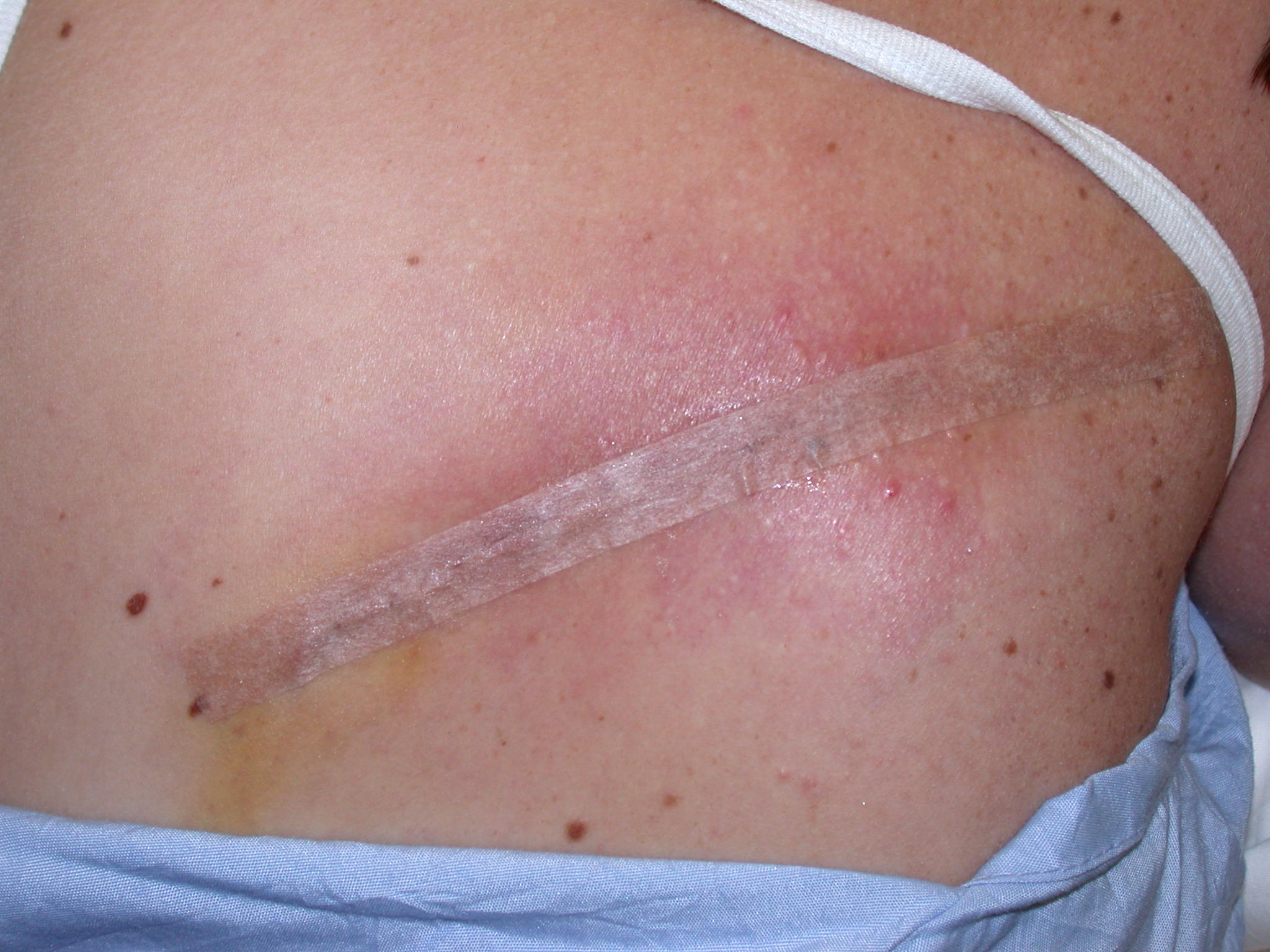 Tattoo Removal Excision The Cosmetic & Skin Surgery Center