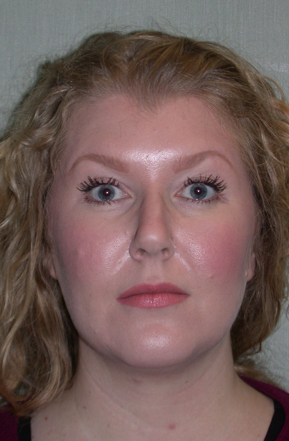 Ultherapy™ The Cosmetic & Skin Surgery Center