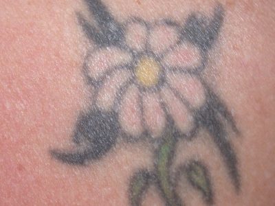 Laser Tattoo Removal The Cosmetic Skin Surgery Center