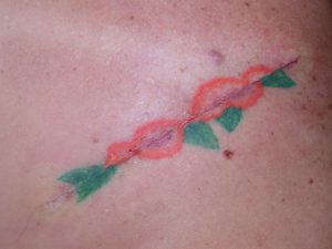Tattoo Removal: Excision - The Cosmetic and Skin Surgery Center