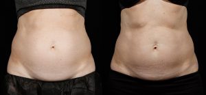 Best Non-Invasive Body Contouring, SculpSure Maryland